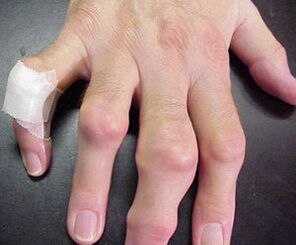 Fingers cause pain with deformation of the joints