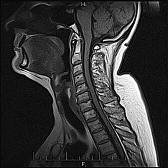 Diagnosis of cervical osteochondrosis