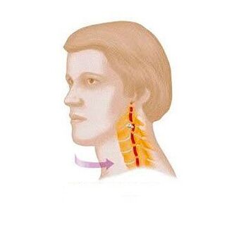 Spinal syndrome with cervical osteochondrosis