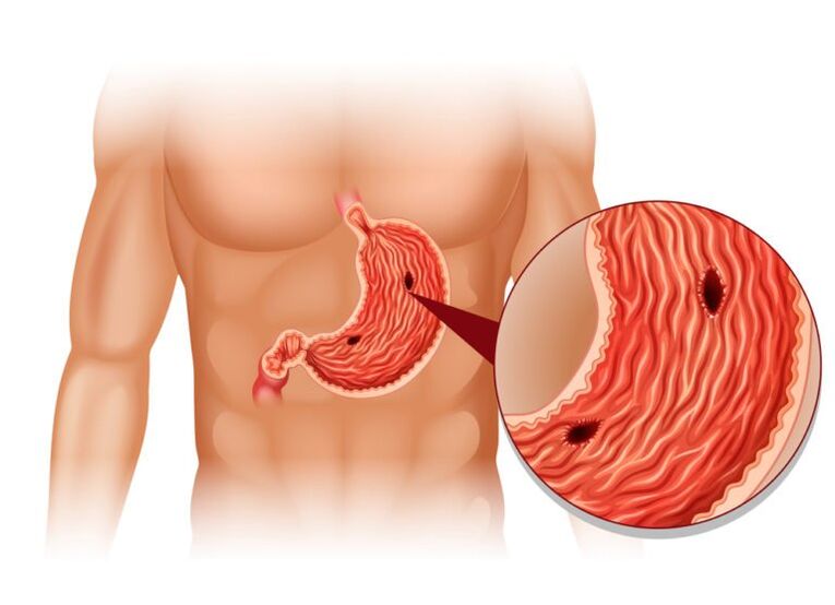 Ulcer as a cause of pain in the left back