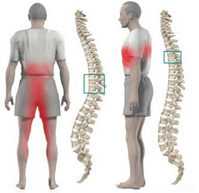 Spinal pain during chest osteochondrosis