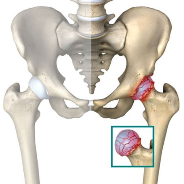 Arthrosis of the femoral joint