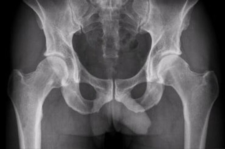 X-ray of the thigh joint for pain