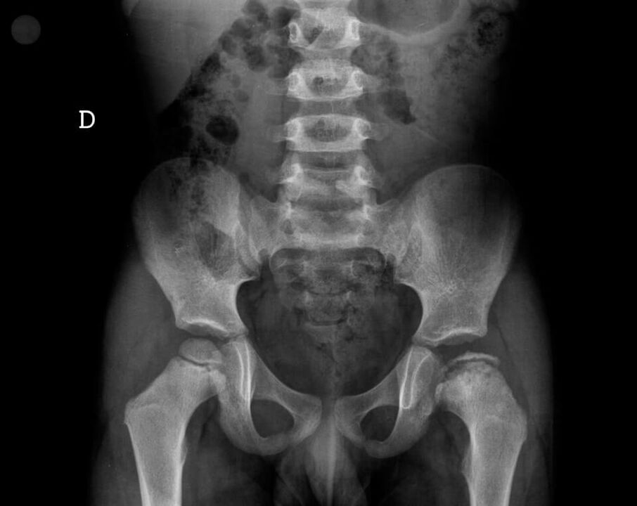 Legg-Calve-Pertes disease - necrosis of cartilage tissue of the femoral head