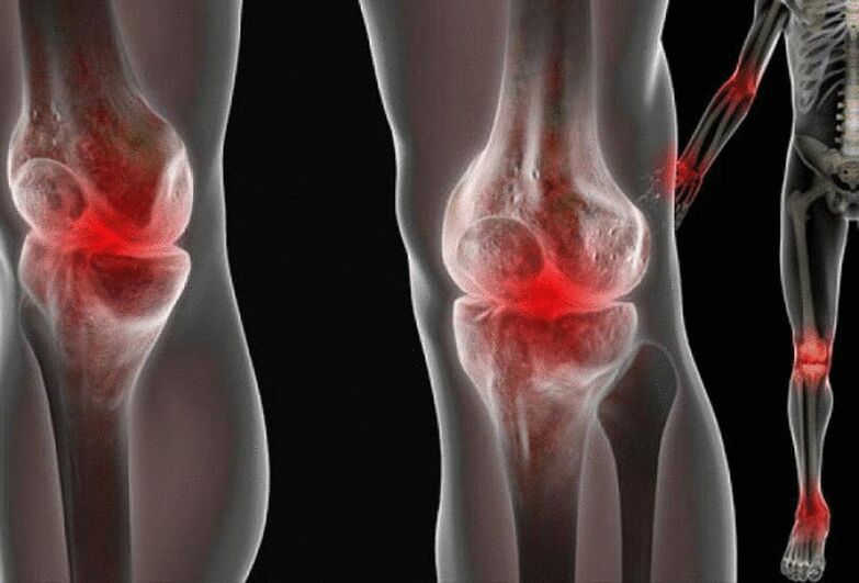 Pain in the joints of the arms and legs caused by various diseases