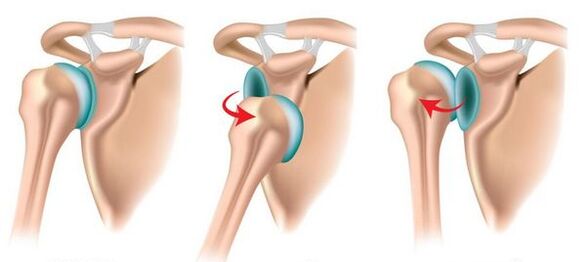 Front and back dislocation of the shoulder joint, provoking the development of arthrosis