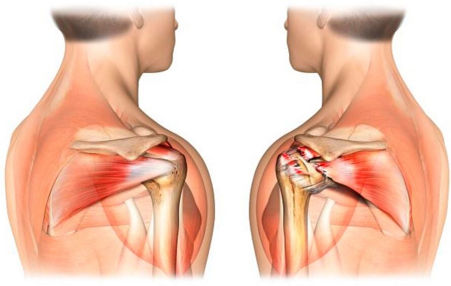 Healthy and arthritic shoulders