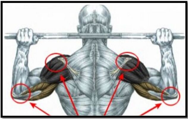 The load on the shoulder and elbow muscles is one of the causes of shoulder joint arthrosis