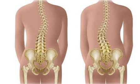 Not sustainable scoliosis