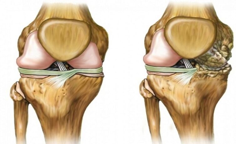 Healthy and affected with arthrosis joint