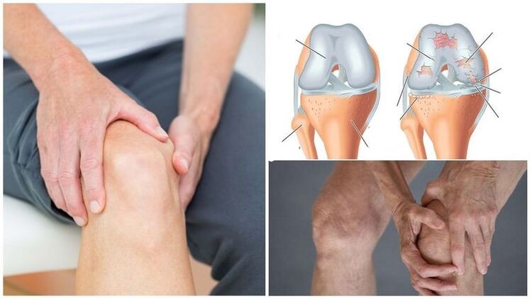 Knee Pain Symptom Knee Arthrosis