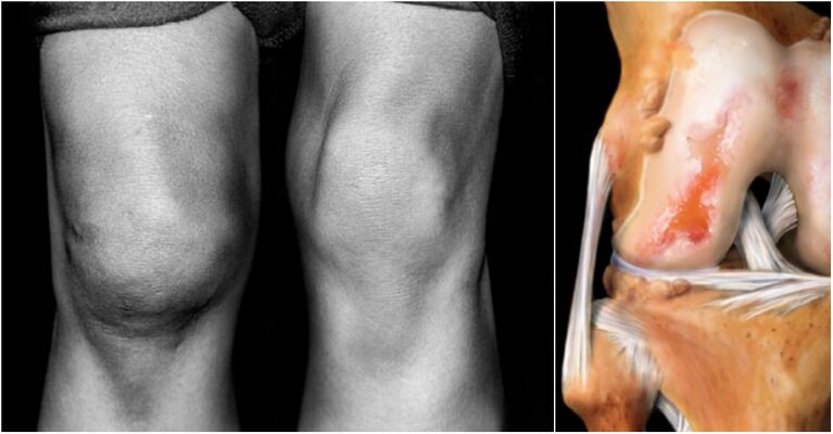 Knee joint and pain arthrosis