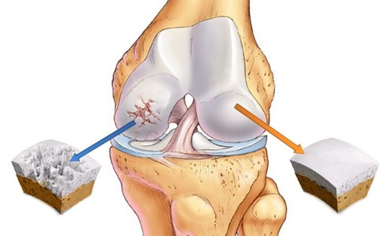 Normal cartilage and affected arthrosis