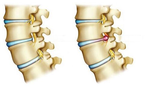 A healthy disc and a herniated disc