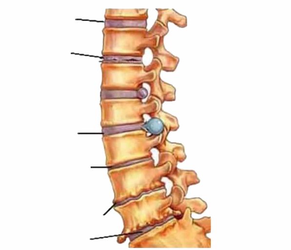 Injury to the spine causes back pain