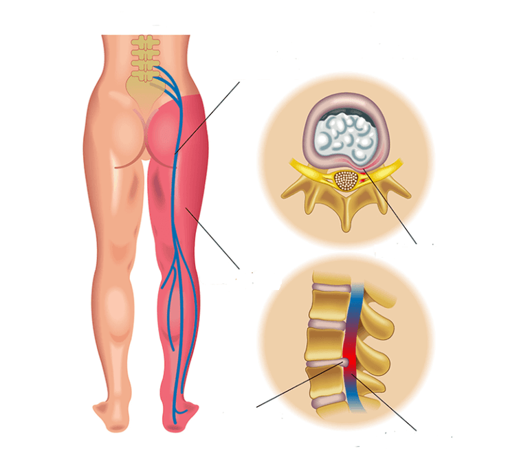 Lumbosacral sciatica