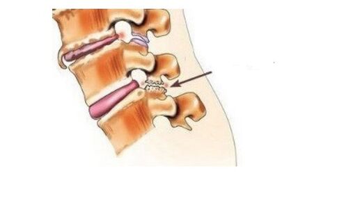 Spondyloarthrosis causes back pain