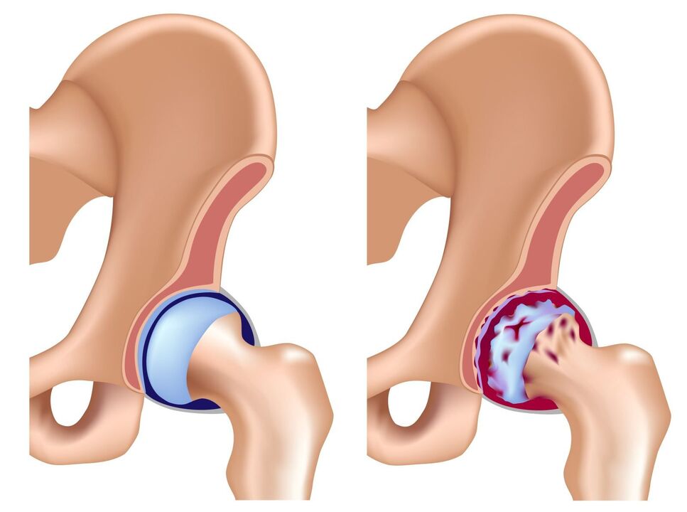 Comparison of healthy joint and arthrosis
