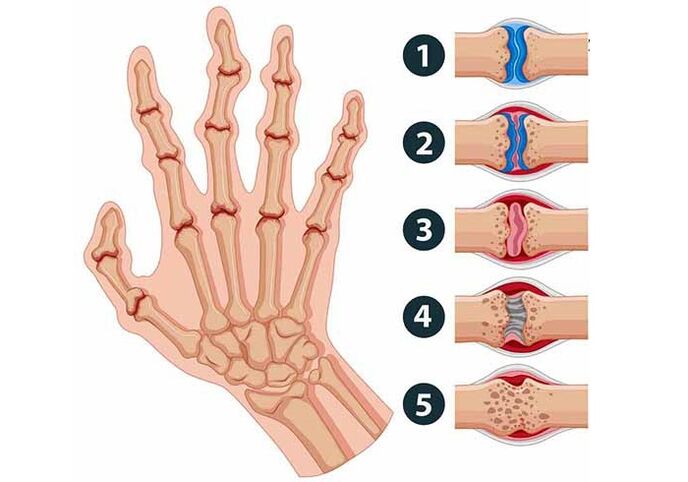 Stages of development of arthritis of finger joints