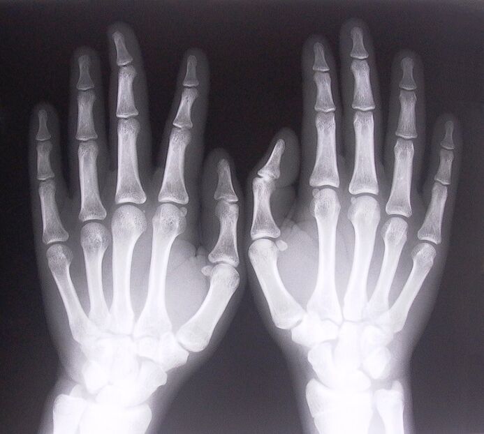 X-ray as a means of diagnosing finger joint pain