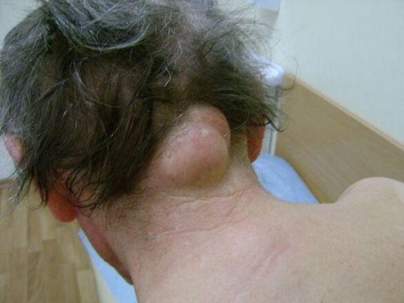 Swelling of the neck as a cause of pain