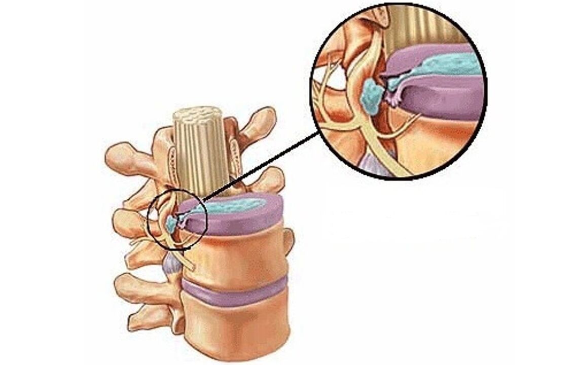 Intervertebral hernia with thoracic osteochondrosis