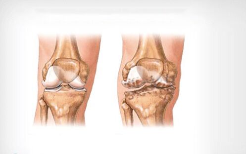 Arthrosis of the knee joint