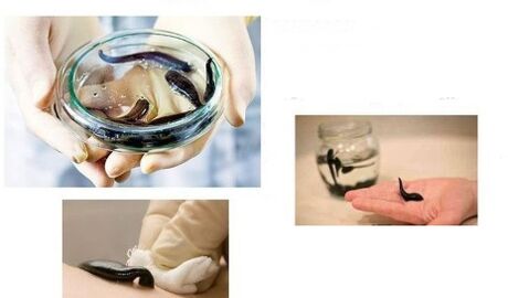Hirudotherapy in arthrosis