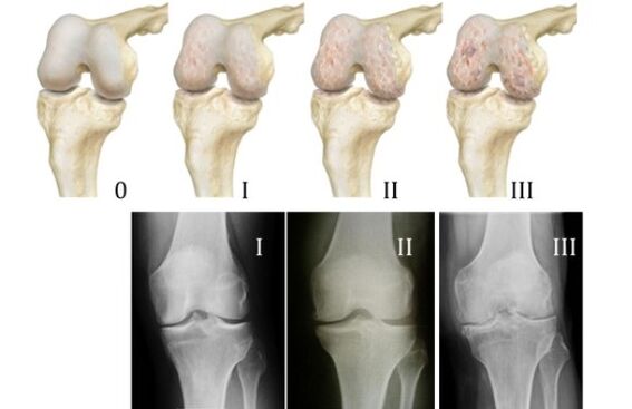 Methods of knee arthrosis diagnosis