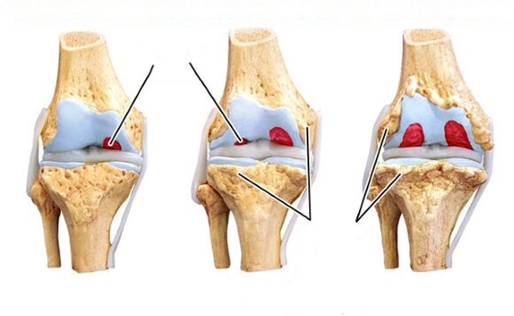 Stages of knee arthrosis